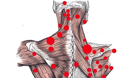 Trigger points in muscles that cause myofascial back pain