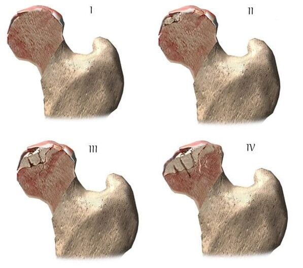 Stages of osteoarthritis of the hip joint