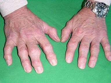 Osteoarthritis of the fingers