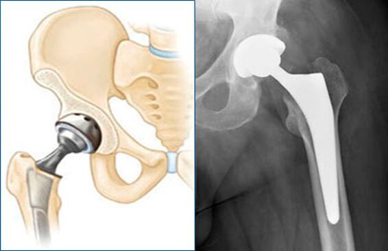 Complete hip replacement