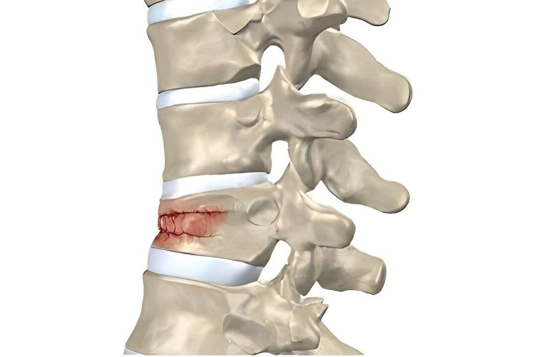 Degree of spinal damage