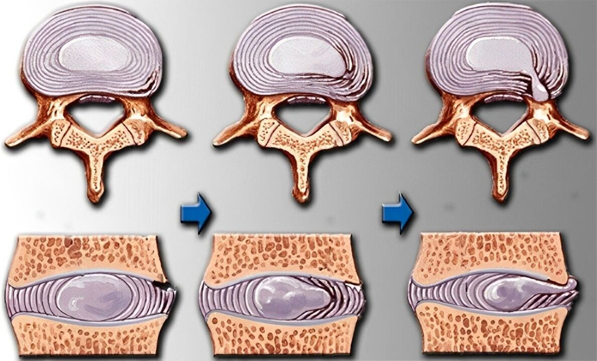 Stages of osteochondrosis