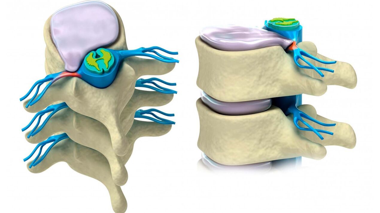 damaged intervertebral disc