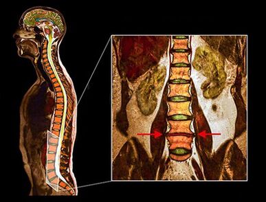 Degenerative hard drive in the spine