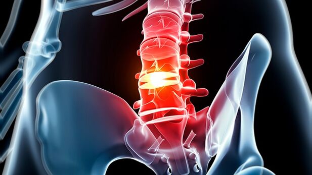 Osteochondrosis of the lumbar spine