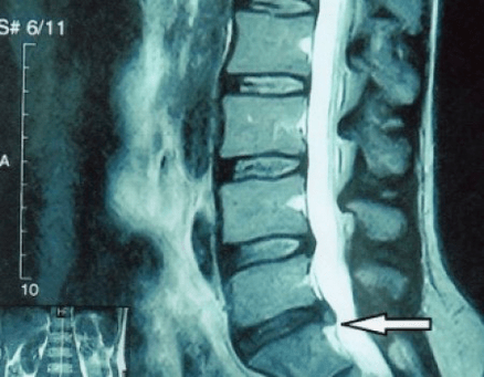 Bulging of an intervertebral disc in the MRI