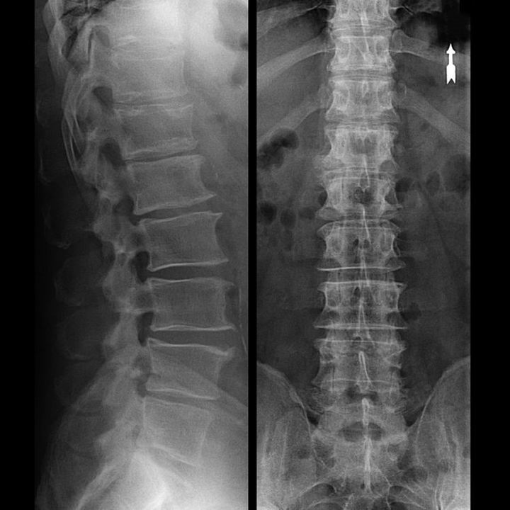 Osteochondrosis of the vertebral region on x-ray