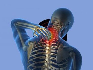 A person with osteochondrosis of the cervical spine experiences neck pain